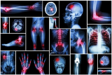 Does CBD Oil Help Treat Arthritis Pain?