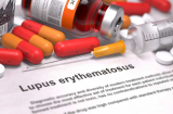 Lupus Symptoms and Causes and how CBD can Help